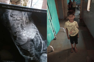 જે કામ દુનિયાનો કોઈ ડૉક્ટર પૈસા લઈને પણ ના કરી શક્યો તે કામ સુરતના સરકારી ડૉક્ટરે મફતમાં કરી દીધું