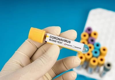 કોરોના: રાજ્યમાં 394 નવા કેસ સાથે કુલ આંક 7,797 પર પહોંચ્યો, જાણો તમામ વિગત