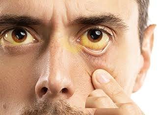 કમળો થાય ત્યારે શું ખાવું અને શું ન ખાવું ? જાણો સમગ્ર વિગત