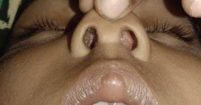 બંધ નાકની સમસ્યાથી રહો છો પરેશાન ? તો આ આર્ટિકલમાં જાણો બંધ નાક ખોલવાના સરળ ઉપાયો