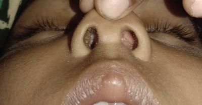 બંધ નાકની સમસ્યાથી રહો છો પરેશાન ? તો આ આર્ટિકલમાં જાણો બંધ નાક ખોલવાના સરળ ઉપાયો