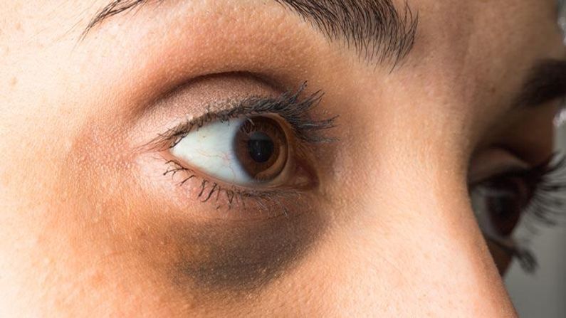 Eye Tips: જો તમને પણ ડાર્ક સર્કલની સમસ્યા છે તો આંખની આસપાસની ત્વચાનું આ રીતે રાખો ધ્યાન