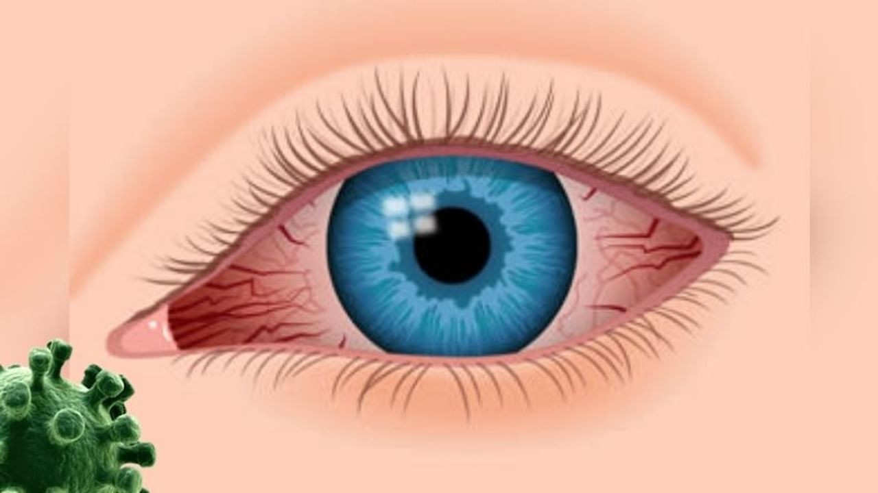 હળવી લાલ આંખો - ચીનમાં તાજેતરના એક અભ્યાસ મુજબ નવા સ્ટ્રેઈનને જોયા પછી કેટલાક વિશેષ લક્ષણોની ઓળખ કરવામાં આવી છે. ચેપના નવા પ્રકારમાં, વ્યક્તિની આંખોનો રંગ આછો લાલ અથવા ગુલાબી થઈ શકે છે. આંખોમાં લાલાશ ઉપરાંત આંખોમાં સોજો અને પાણી આવવાનીની ફરિયાદો હોઈ શકે છે.