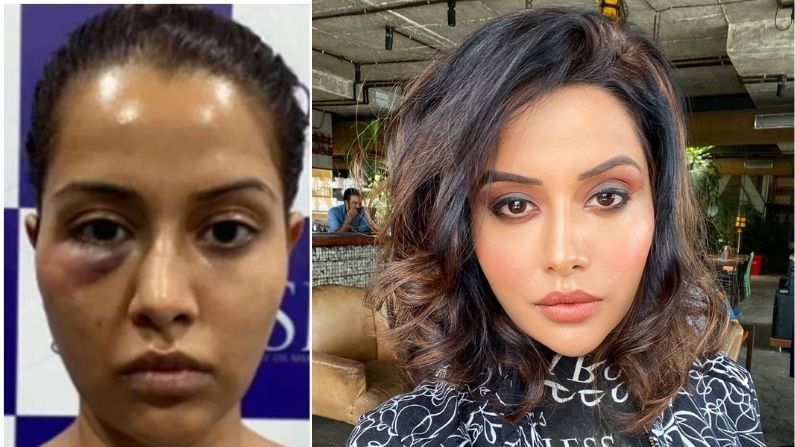 Tamil Actor Raiza Wilson’s Face Treatment Goes Wrong