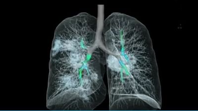 સાવધાન : ​​શ્વાસ લેવામાં તકલીફ છે, તો સમજી જાવ કે કોરોનાનો ચેપ ફેફસામાં પહોંચી ગયો છે