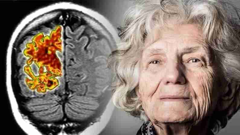 Alzheimers Disease: અમેરિકાએ 20 વર્ષ સુધી વિચાર કર્યા બાદ આ ખતરનાક રોગની દવાને આપી મંજૂરી, જાણો આ અસાધ્ય રોગ વિશે