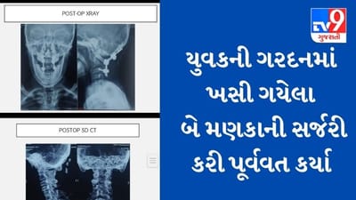 AHMEDABAD : સિવિલના સર્જનોએ જટિલ સ્પાઈન સર્જરી સફળતાપૂર્વક પાર પાડી, યુવકની ગરદનમાં ખસી ગયેલા મણકા પૂર્વવત કર્યા