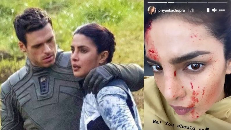 Priyanka chopra shared a picture of Injured Face while shooting for the Citadel (1)