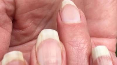 Alert: જો તમારા નખ વારંવાર તૂટી જાય છે તો ચેતી જજો, આ બીમારીઓના હોઈ શકે છે સંકેત