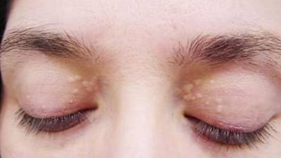 આંખની આસપાસ જોવા મળતા સફેદ નિશાનને ના ગણો સામાન્ય, જાણો આ થવાનું કારણ અને તેના ઉપાયો!