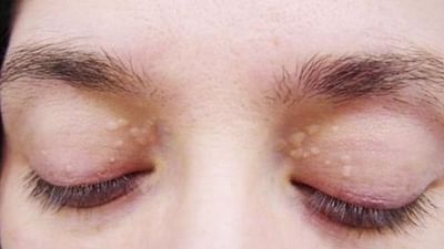 આંખની આસપાસ જોવા મળતા સફેદ નિશાનને ના ગણો સામાન્ય, જાણો આ થવાનું કારણ અને તેના ઉપાયો!