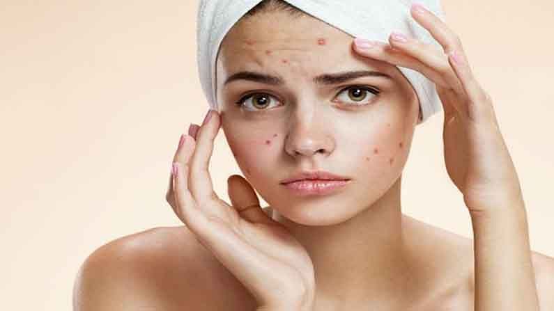 Skin Care : તમે ચેહરા પર ખીલના ડાઘથી પરેશાન છો, અપનાવો આ ઘરેલું ઉપાયો