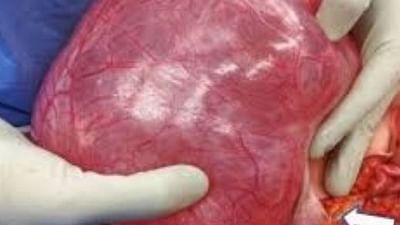 25 વર્ષના છોકરાની છાતીમાં હતી 14 કિલોની ગાંઠ, ડોકટરોએ સર્જરી કરી બચાવ્યો જીવ્યો