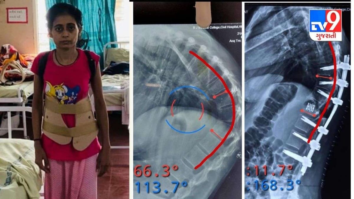 અમદાવાદ સિવિલમાં તન્વીબેન મણકાની અત્યંત રેર અંકાયલોસિંગ સ્પોન્ડાયલોસીસ બીમારીથી મુક્ત થયા