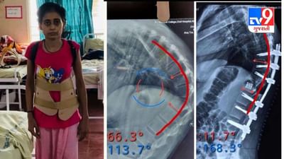 અમદાવાદ સિવિલમાં તન્વીબેન મણકાની અત્યંત રેર અંકાયલોસિંગ સ્પોન્ડાયલોસીસ બીમારીથી મુક્ત થયા