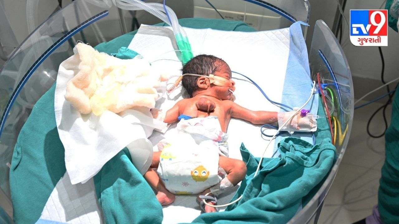 હિંમતનગરમાં એક બાળક શરીરની બહાર હૃદય  સાથે જન્મ્યું, જાણો 10 લાખે 5 બાળકોમાં જોવા મળતી આ બીમારી વિશે
