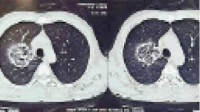 Surat : સુરતમાં બ્લેક ફંગસનો અજીબ કિસ્સો, દર્દીના ફેફસામાં જોવા મળ્યું ઇન્ફેક્શન