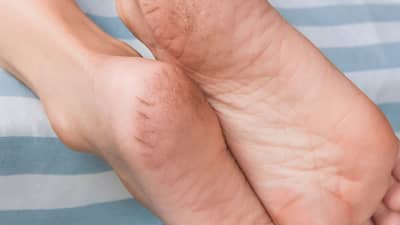 Lifestyle: શિયાળાની શરૂઆત થતાંની સાથે જ સતાવી રહી છે ફાટેલી એડીની સમસ્યા? અજમાવી જુઓ આ ઘરેલુ ઉપાય