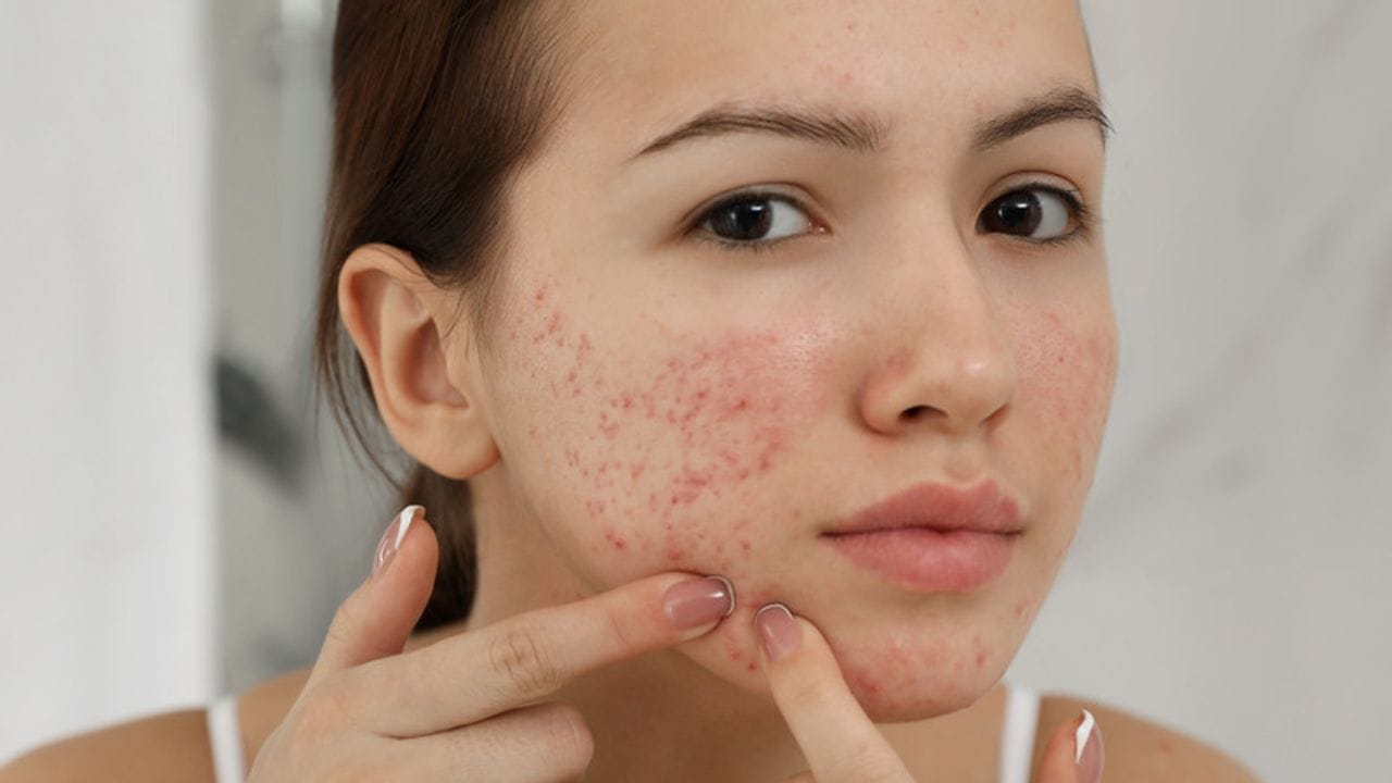 Beauty Tips : ચહેરાની સુંદરતા બગાડતા ખીલની સમસ્યા દૂર કરવાના આ રહ્યા ઉપાયો  - Gujarati News | Beauty Tips: Here are some tips to help you get rid of  acne - Beauty
