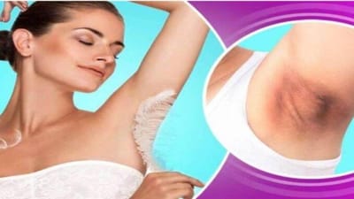 સ્વચ્છતા ન રાખવીઃ જો શરીરના આ ભાગમાં સ્વચ્છતાનું ધ્યાન ન રાખવામાં આવે તો તેના કારણે અંડરઆર્મ્સમાં પણ ડાર્કનેસ થઇ શકે છે. જેથી માટે સ્નાન કરતી વખતે અંડરઆર્મ્સને સાફ કરવું ખૂબ જ જરૂરી છે.
