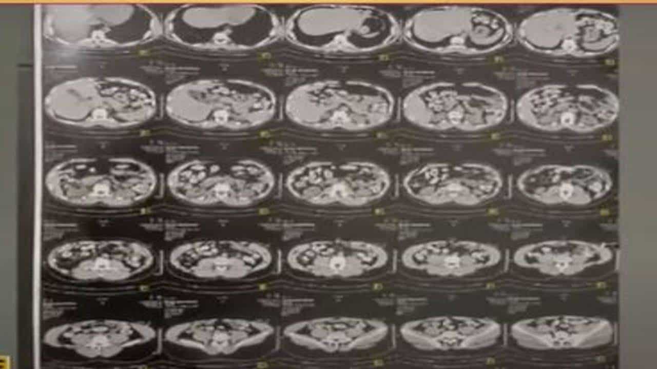 Ahmedabad: આફ્રિકન યુવક-યુવતીના પેટમાંથી નીકળેલી કેપ્સ્યુલમાં મળ્યુ 1.8 કિલો હેરોઇન, જાણો કેવી રીતે આ ઓપરેશન પાર પડાયુ