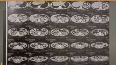 Ahmedabad: આફ્રિકન યુવક-યુવતીના પેટમાંથી નીકળેલી કેપ્સ્યુલમાં મળ્યુ 1.8 કિલો હેરોઇન, જાણો કેવી રીતે આ ઓપરેશન પાર પડાયુ