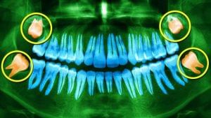 શું ડહાપણ દાંત આવવાથી સમજદારી વધી જાય છે? જાણો તેનું વૈજ્ઞાનિક કારણ અને ક્યારે નિકળે છે
