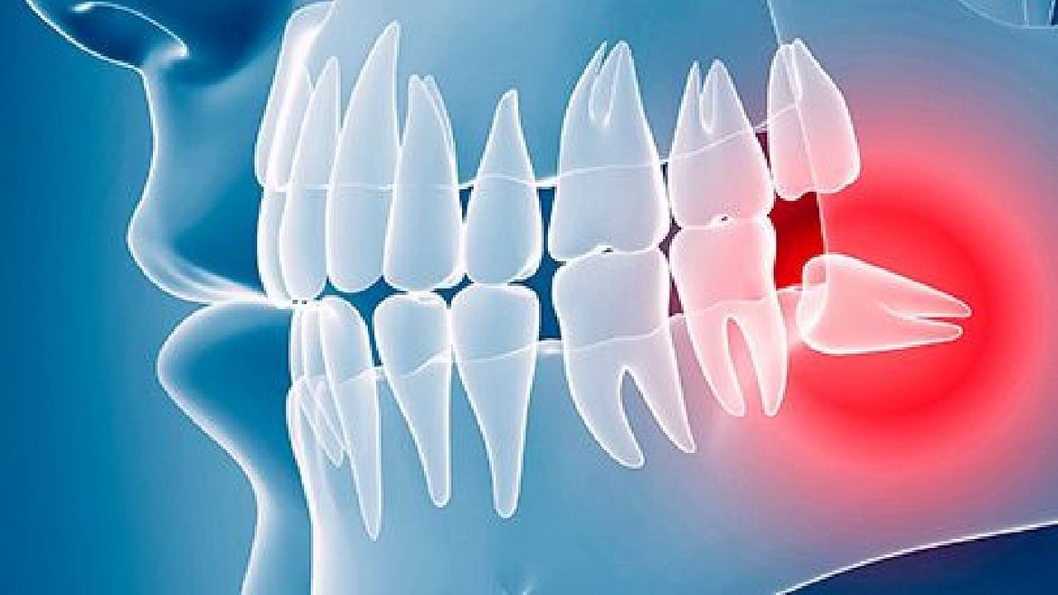 વેબએમડીનો રિપોર્ટ કહે છે કે ડહાપણના દાંત તેમની સાથે સમસ્યાઓ પણ લાવે છે. એકલા યુ.એસ.માં, ડહાપણના દાંતને દૂર કરવા માટે દર વર્ષે 10 મિલિયન સર્જરી કરવામાં આવે છે. ડહાપણના દાંતને કારણે ઘણી સમસ્યાઓ ઊભી થાય છે. જેમાં કેવિટી પ્રોબ્લેમ, ઈન્ફેક્શન, દાંતની આસપાસ ડેમેજ અને હાડકાંને કારણે આસપાસના વિસ્તારમાં નુકસાન સહિતની સમસ્યાઓનો સમાવેશ થાય છે.