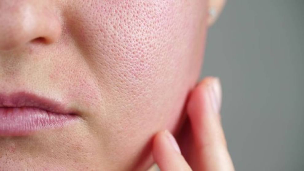 પોર્સની સફાઈ: પોર્સમાં રહેલી ગંદકીને કારણે ત્વચા પર પિમ્પલ્સ અને ખીલની સમસ્યા રહે છે. આવી સ્થિતિમાં, ચહેરાને લેમન સ્ટીમિંગ આપીને છિદ્રોને અંદરથી સાફ કરી શકાય છે.

