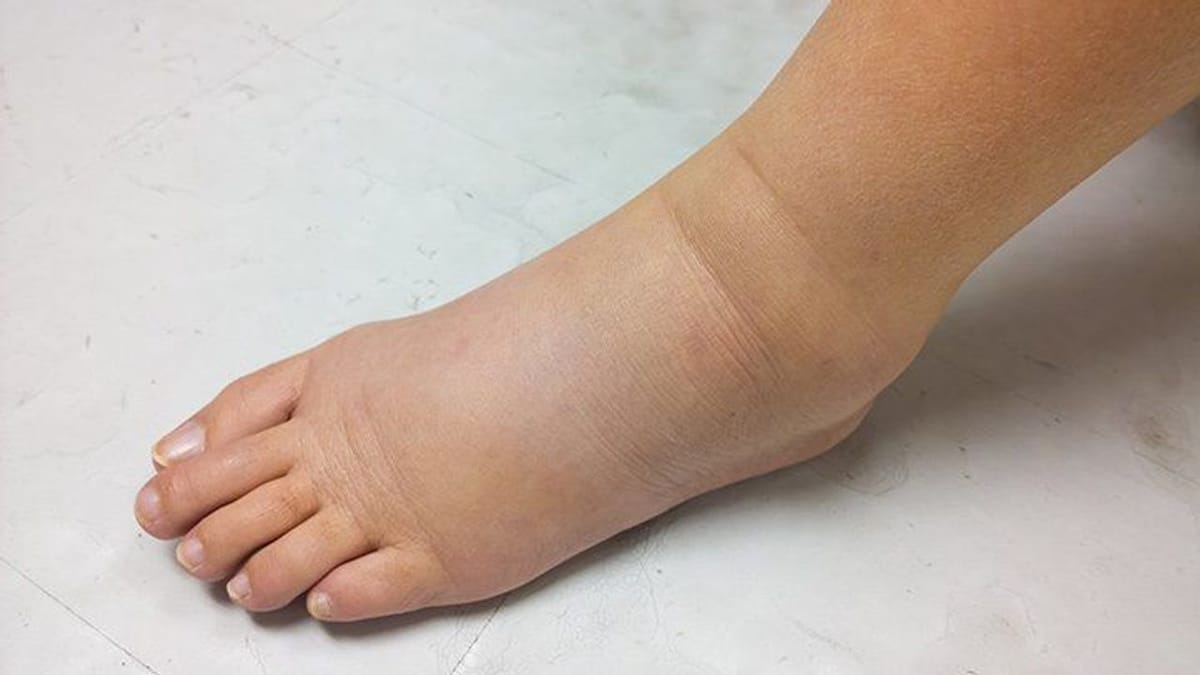 પગમાં સોજો : આવી સ્થિતિમાં રાહત મેળવવા શું લેશો આહાર, અને શું કરશો ઉપાય?