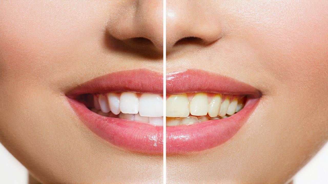 Teeth Whitening at home: પીળા દાંતને કારણે હસવું મુશ્કેલ બની ગયું છે ? તો આજે જ અજમાવો આ નુસખા, મિનિટોમાં જ ચળકશે દાંત