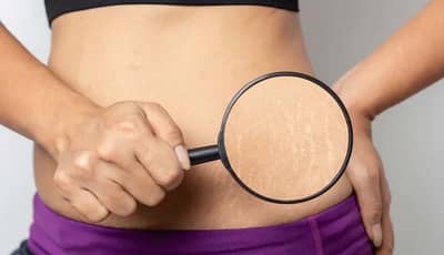 શું તમે જાણો છો પ્રેગ્નન્સીમાં સ્ટ્રેચ માર્ક્સ ફેલાય છે ? જાણો તેના વિશે કેટલીક ગેરસમજ