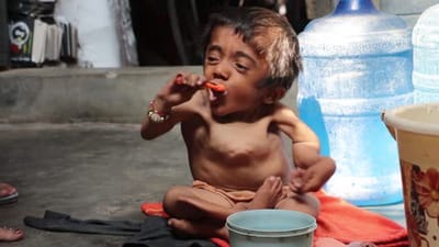 Glass Bone Disease : કાચની જેમ હાડકા તૂટી જવાની આ દુલર્ભ બીમારી શું છે ? જાણો આ આર્ટિકલમાં