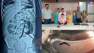 Ahmedabad : 7 વર્ષનું બાળક 14 ચુંબકીય મણકા ગળી ગયું, તબીબોએ ભારે જહેમત બાદ બાળકને મોતના મુખમાંથી ઉગાર્યો