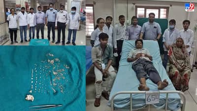 અમદાવાદ : શાકભાજી વેચતા વ્યક્તિની કિડનીમાંથી 250થી વધુ પથરીનું તબીબોએ સફળ ઓપરેશન કર્યું