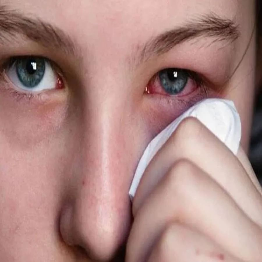 આંખોમાં લાલાશ: બાળકની આંખોમાં લાલાશ પણ કોવિડ-19નું લક્ષણ હોઈ શકે છે. અથવા આંખોમાં લાલ ચકામાં પણ હોઈ શકે છે. આ સ્થિતિમાં તેને શાળાએ મોકલવાને બદલે ડોક્ટર પાસે તેની સારવાર કરાવો.