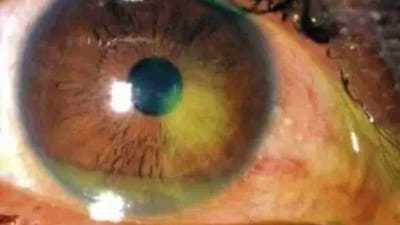 શું તમે પણ અપુર્તિ ઉંઘથી પીડાવ છો તો ચેતી જજો આ બિમારી અંધાપા તરફ દોરી જાય છે