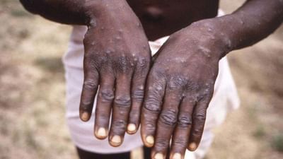 Monkeypox: મંકીપોક્સ અંગે કેન્દ્ર સરકારનું એલર્ટ, રાજ્યો માટે જાહેર માર્ગદર્શિકા, 21 દિવસ સુધી દર્દીઓ પર રહેશે નજર