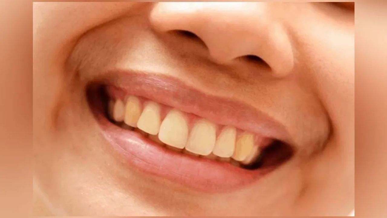 આ 5 વસ્તુઓ તમારા દાંતમાં પીળાશ લાવે છે, ખાતી વખતે રાખો સાવધાની