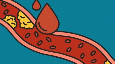 Heart Problems: આ લક્ષણો છે શરીરમાં કોલેસ્ટ્રોલ વધવાના સંકેત, તરત જ ડોક્ટરની સલાહ લો