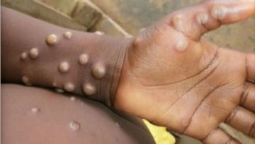 Monkeypox: મંકીપોક્સ વાયરસથી લોકોના થવા લાગ્યા મોત, નાઇજીરિયામાં થયું પ્રથમ મોત, કોંગોમાં 22 લોકોએ જીવ ગુમાવ્યા