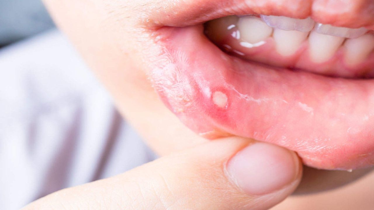 Mouth Ulcer : આ ઘરેલુ ઉપાય અજમાવીને રાતોરાત મોઢાના ચાંદા કરો દૂર