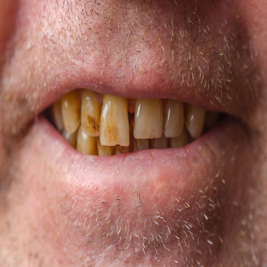 તમાકુ - તમાકુ સ્વાસ્થ્ય માટે ખૂબ જ હાનિકારક છે. દાંત પર તેની ખૂબ જ ખરાબ અસર પડે છે. ધૂમ્રપાન અને તમાકુ ચાવવાથી દાંત પર ડાઘ પડી શકે છે. તેથી તમાકુથી અંતર રાખો.