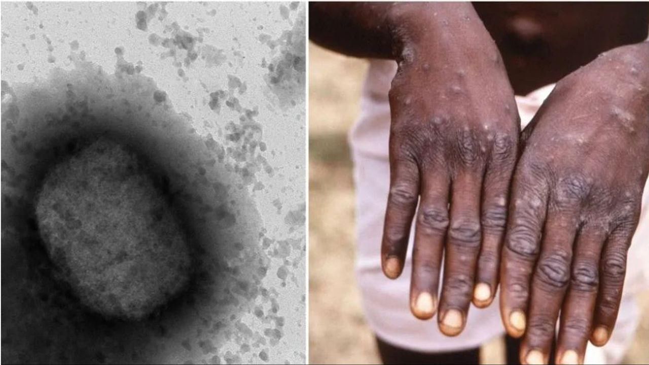 Monkeypox Virus:  મંકીપોક્સ વાયરસ 20 દેશોમાં પહોંચ્યો, 200 કેસની પુષ્ટિ, WHOએ નિવેદન બહાર પાડ્યું