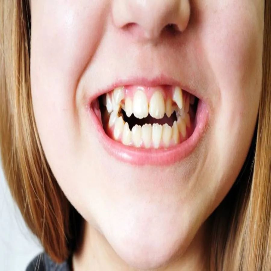  જો તમારા ઘરમાં બાળકોને દાંતનો દુખાવો છે તો તેમને શેરડીનો રસ ન આપવો જોઈએ,જો કે તેમાં પ્રાકૃતિક ખાંડ હોય છે, પરંતુ તે દાંતના સ્વાસ્થ્યને પણ બગાડી શકે છે.