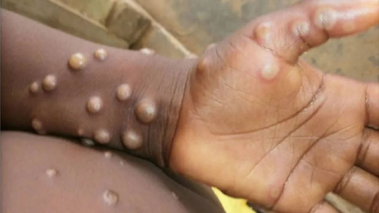 Monkeypox Virus: World Health Network declares monkeypox an epidemic, expert says no need to panic