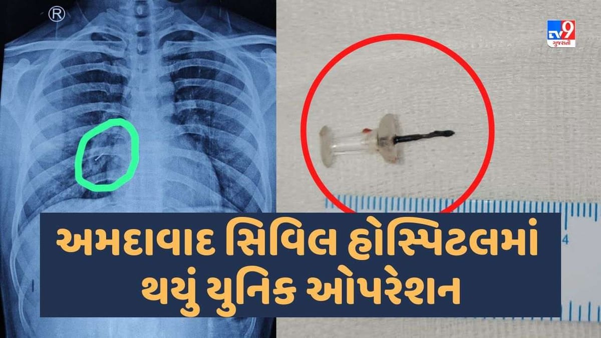 Ahmedabad સિવિલ હોસ્પિટલમાં થયું યુનિક ઓપરેશન, જૂનાગઢના યુવાનને મળી રાહત Ahmedabad સિવિલ હોસ્પિટલમાં થયું યુનિક ઓપરેશન, જૂનાગઢના યુવાનને મળી રાહત
