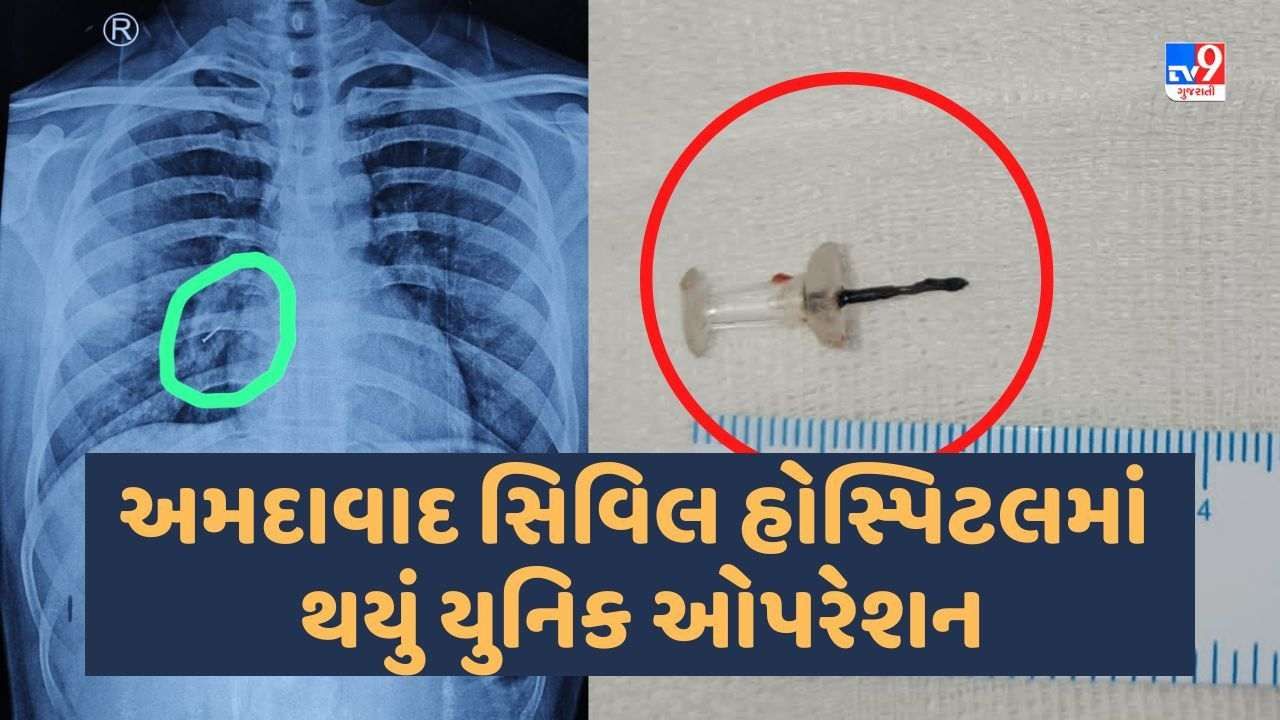 Ahmedabad સિવિલ હોસ્પિટલમાં થયું યુનિક ઓપરેશન, જૂનાગઢના યુવાનને મળી રાહત