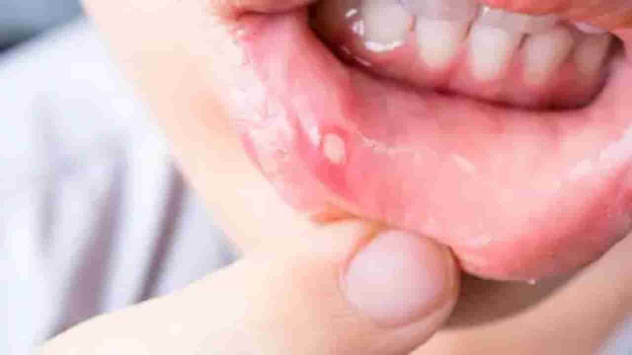 Mouth Ulcers : જો તમે વારંવાર મોઢામાં પડતા ચાંદાથી પરેશાન છો, તો અજમાવો આ ઘરેલું ઉપાય