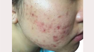 Rosacea: વરસાદની ઋતુમાં Skin Infection થયું છે ? આ છે તેની આયુર્વેદિક સારવાર